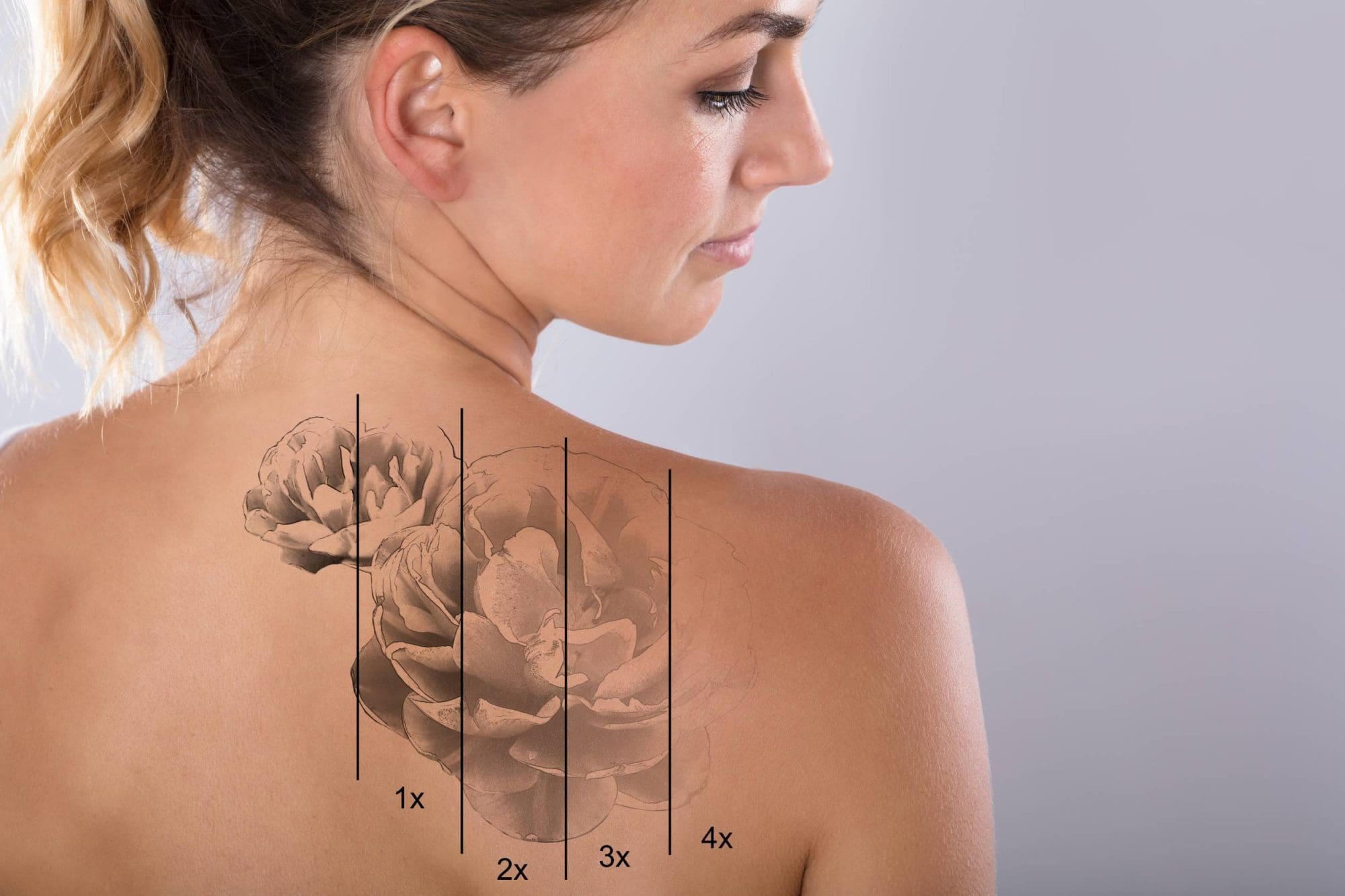 Rimozione Tatuaggio | NanoRemoval