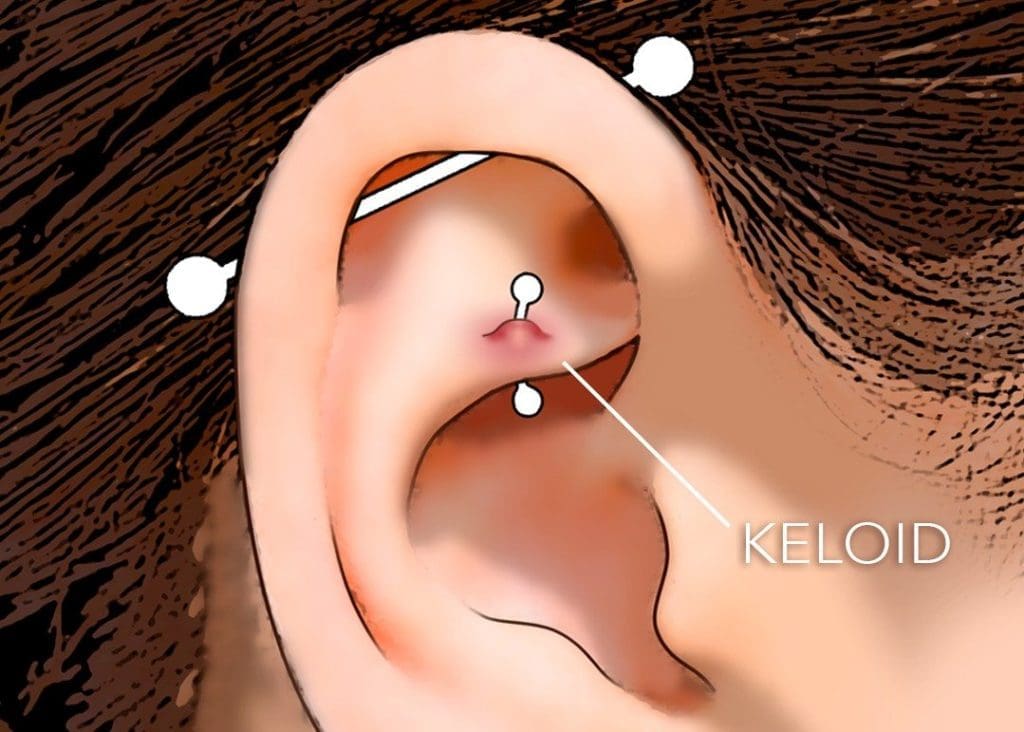Cheloidi da piercing