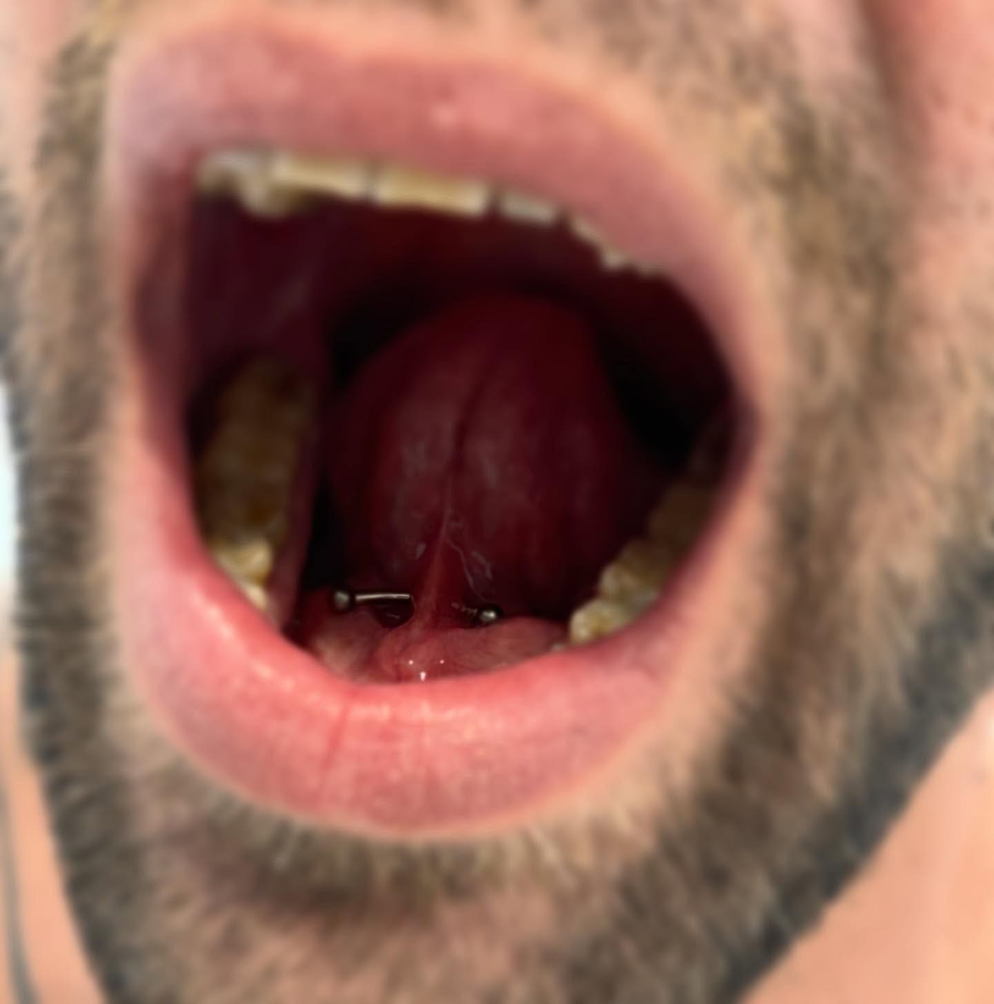 Marley piercing ✨
Un piercing discreto e nascosto che pochi conoscono… ma che può fare davvero la differenza !!!

Si trova nel frenulo sotto la lingua, quindi invisibile a bocca chiusa: perfetto se vuoi qualcosa di particolare ma super riservato.

✔️ Dolore minimo (è una zona molto sottile)
✔️ Guarigione generalmente veloce
✔️ Effetto “wow” solo per chi lo scopre 😉

Non tutti però sono idonei: la valutazione della conformazione è fondamentale prima di eseguirlo.

Tu lo faresti? 👀