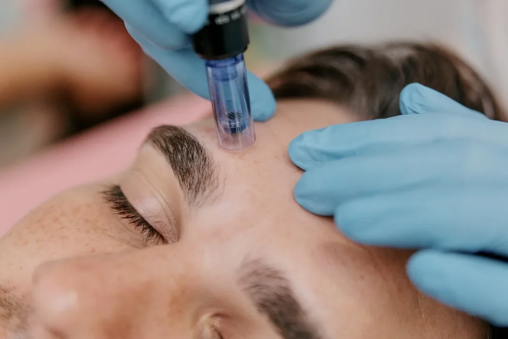 microneedling uomo e donna professionale con dermografo monza brianza